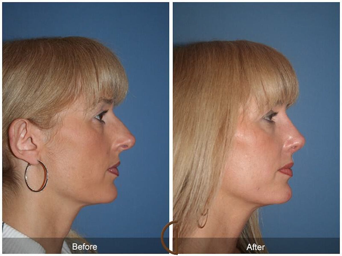 Revision Rhinoplasty Before & After Gallery - Patient 403392 - Image 3