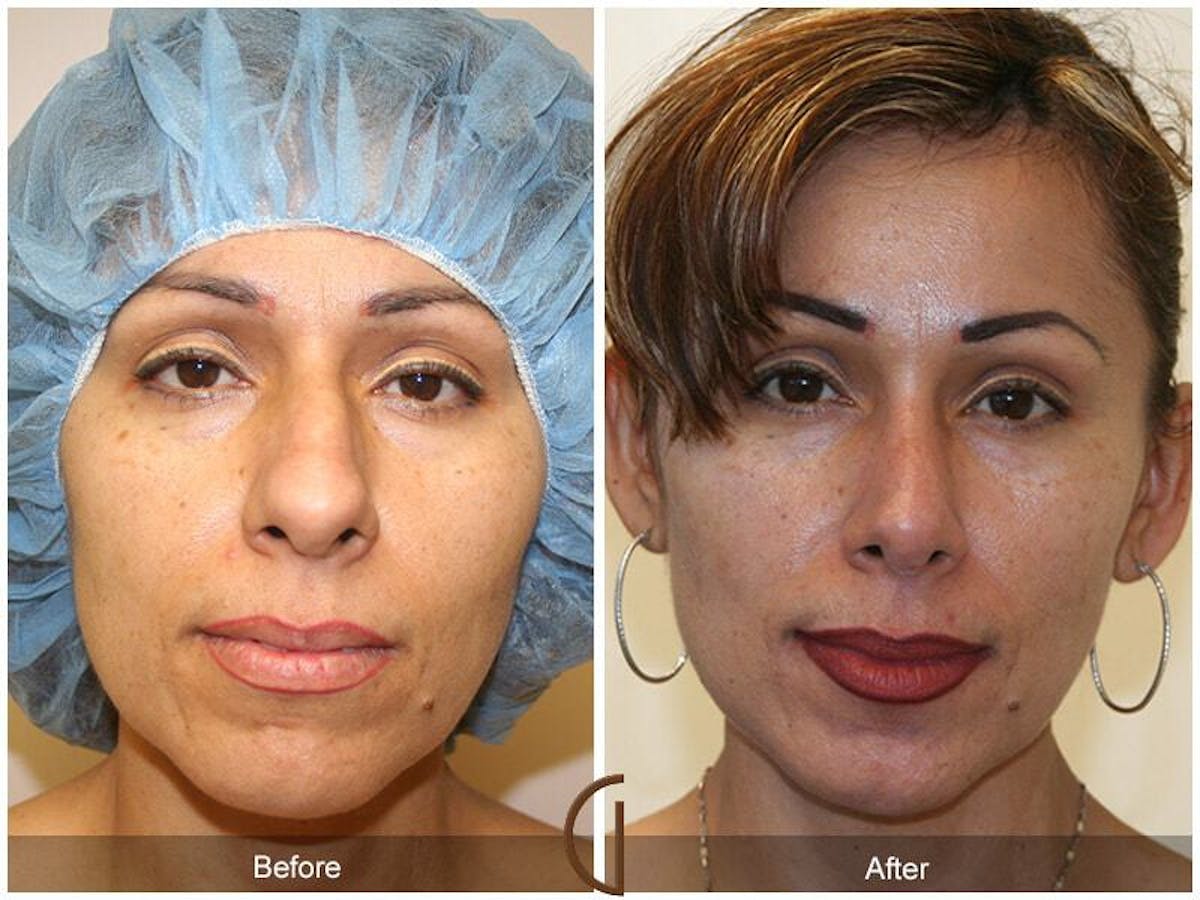 Ethnic Rhinoplasty Before & After Gallery - Patient 339743 - Image 2