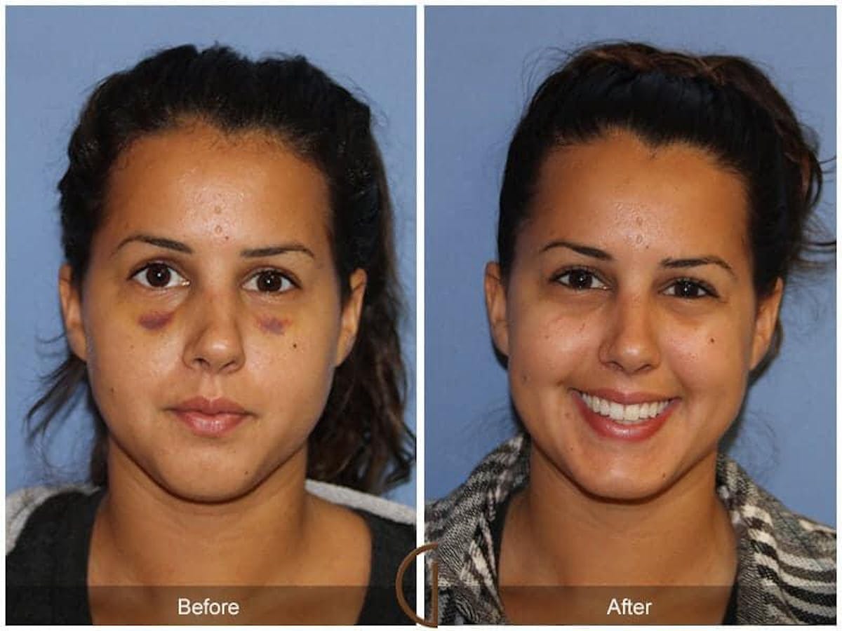 Revision Rhinoplasty Before & After Gallery - Patient 718744 - Image 2