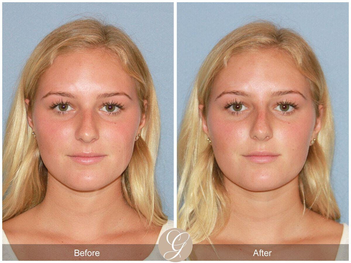 Non Surgical Rhinoplasty Before & After Gallery - Patient 111828 - Image 2