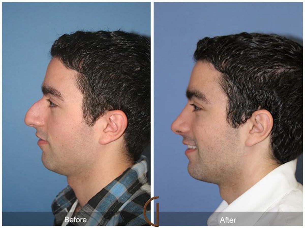 Male Rhinoplasty Before & After Gallery - Patient 119059 - Image 1