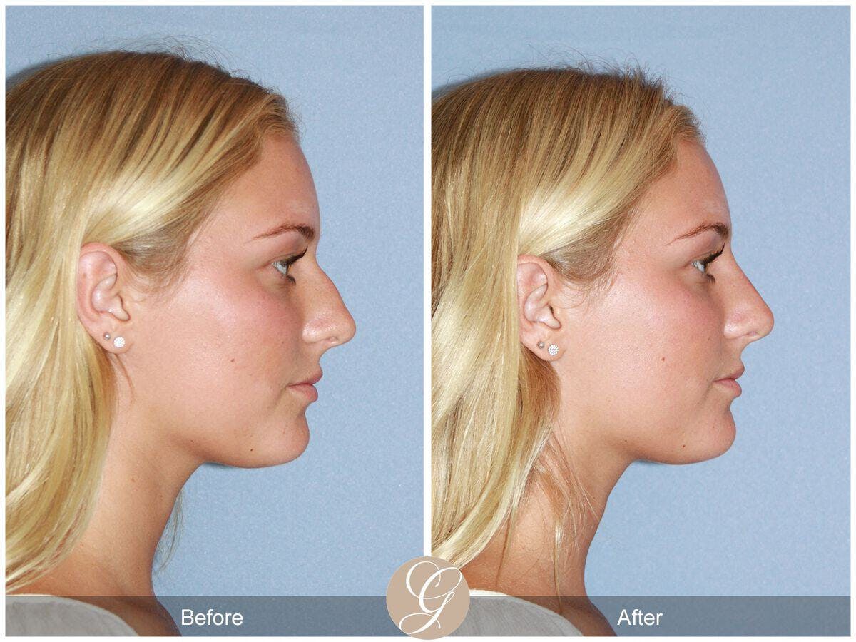 Non Surgical Rhinoplasty Before & After Gallery - Patient 111828 - Image 1