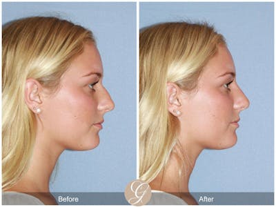 Non Surgical Rhinoplasty Before & After Gallery - Patient 111828 - Image 1