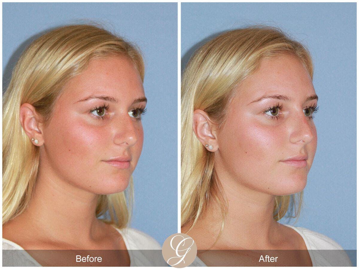 Non Surgical Rhinoplasty Before & After Gallery - Patient 111828 - Image 3