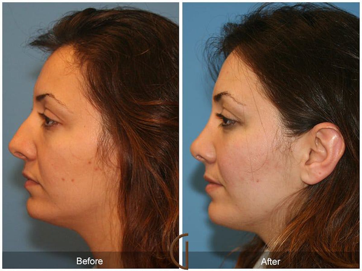 Ethnic Rhinoplasty Before & After Gallery - Patient 344875 - Image 1