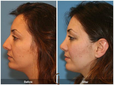 Rhinoplasty Before & After Gallery - Patient 239068 - Image 1