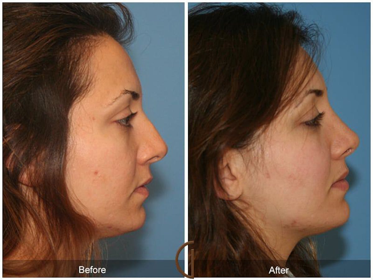 Ethnic Rhinoplasty Before & After Gallery - Patient 344875 - Image 3