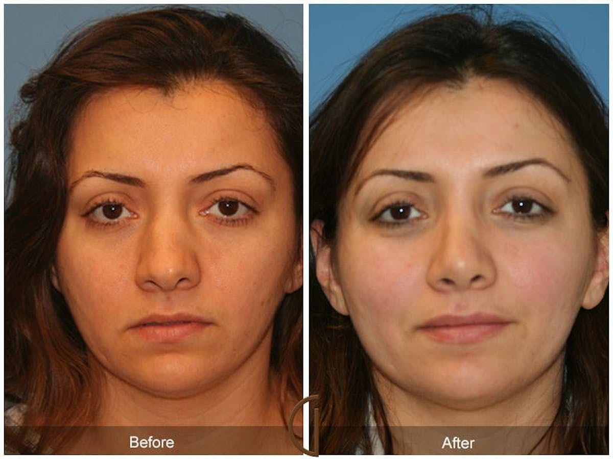Ethnic Rhinoplasty Before & After Gallery - Patient 344875 - Image 2