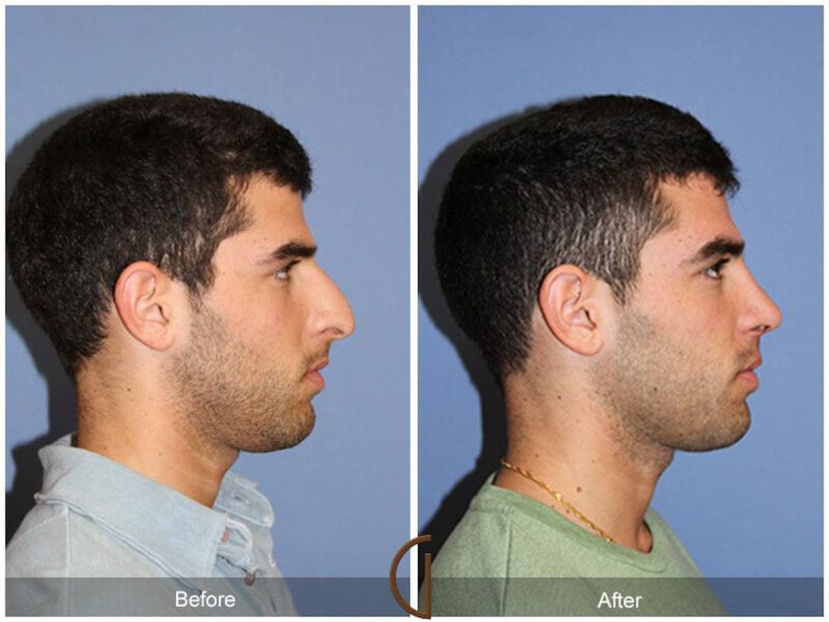 Male Rhinoplasty Before & After Gallery - Patient 220210 - Image 3