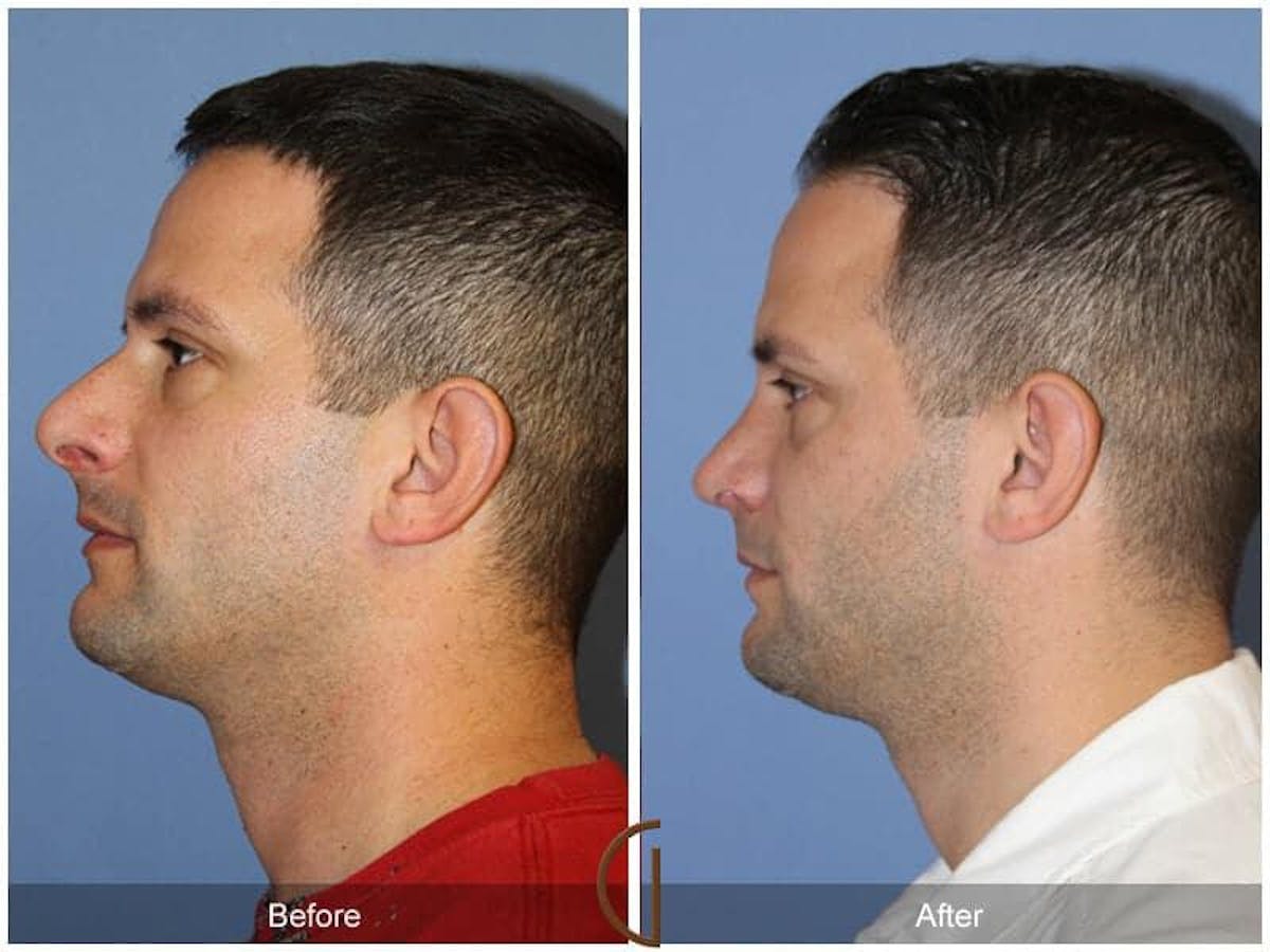 Male Rhinoplasty Before & After Gallery - Patient 248195 - Image 1