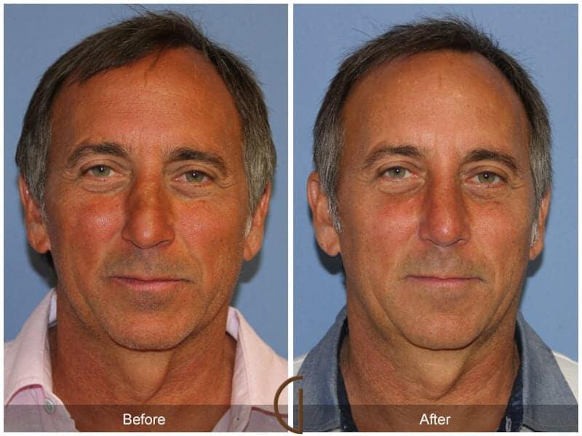 Male Rhinoplasty Before & After Gallery - Patient 133222 - Image 2