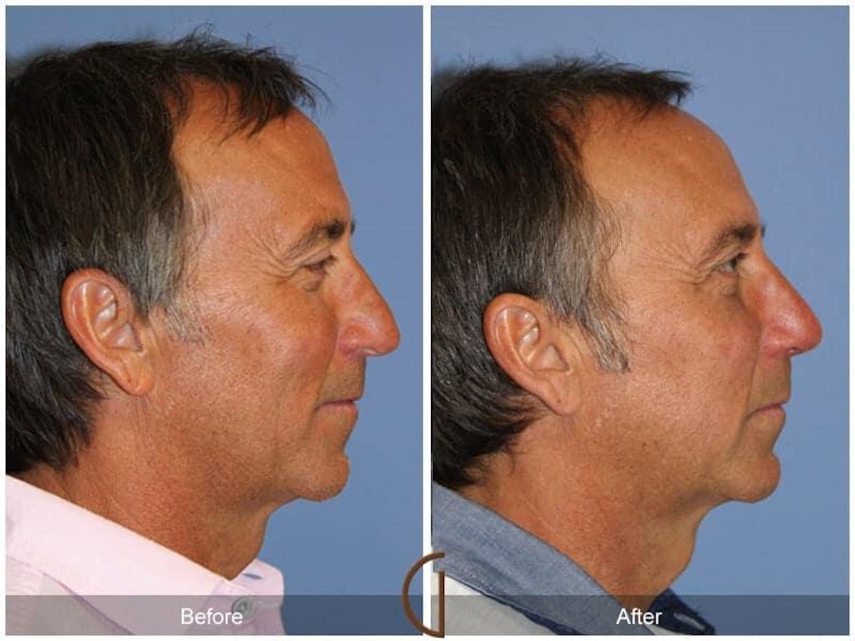 Male Rhinoplasty Before & After Gallery - Patient 133222 - Image 3