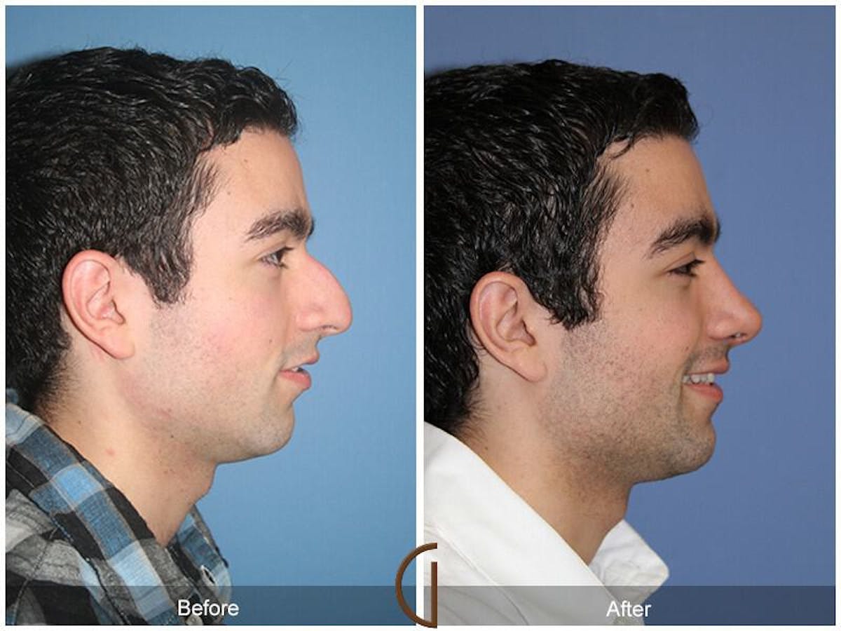 Male Rhinoplasty Before & After Gallery - Patient 119059 - Image 3