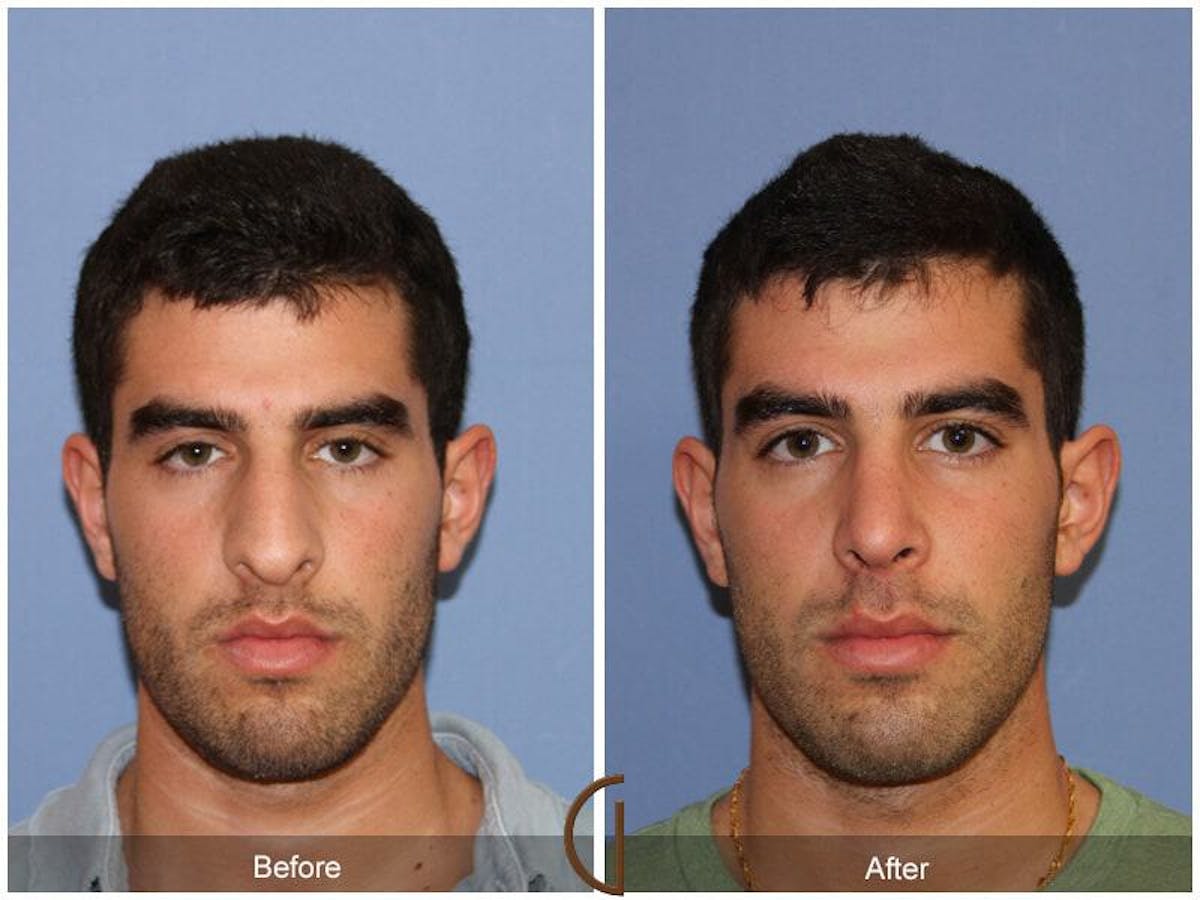 Male Rhinoplasty Before & After Gallery - Patient 220210 - Image 2
