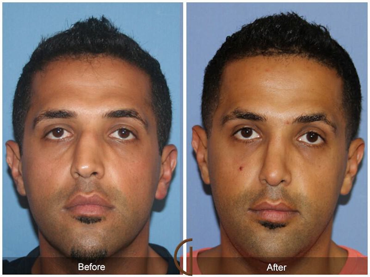 Male Rhinoplasty Before & After Gallery - Patient 135383 - Image 2