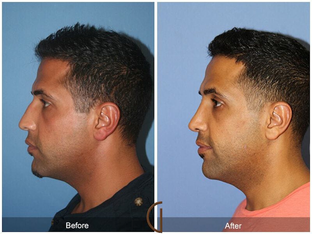 Male Rhinoplasty Before & After Gallery - Patient 135383 - Image 1
