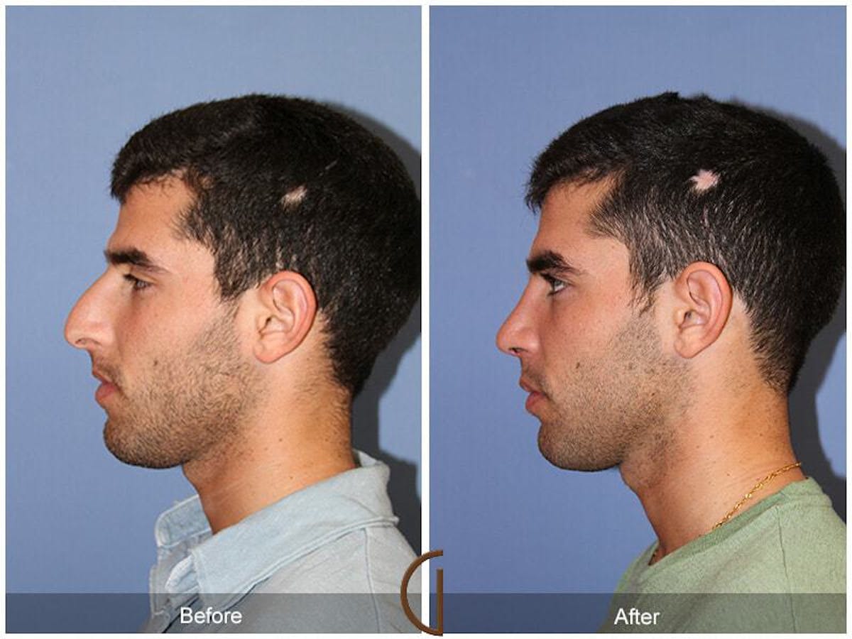 Male Rhinoplasty Before & After Gallery - Patient 220210 - Image 1