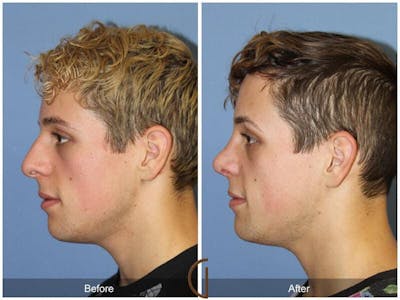 Male Rhinoplasty Before & After Gallery - Patient 179843 - Image 1