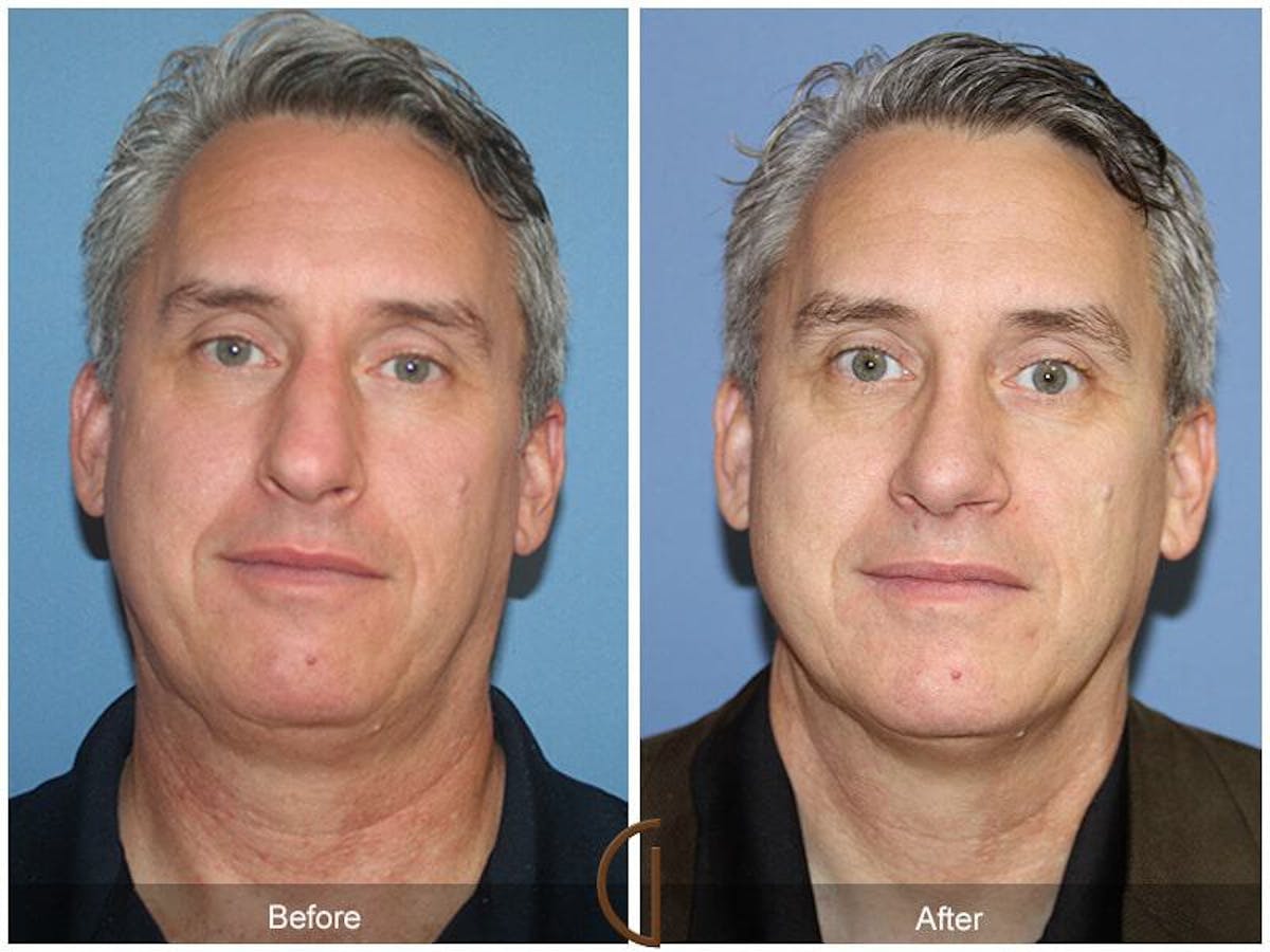 Male Rhinoplasty Before & After Gallery - Patient 132973 - Image 2