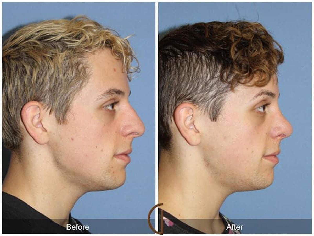 Male Rhinoplasty Before & After Gallery - Patient 179843 - Image 3