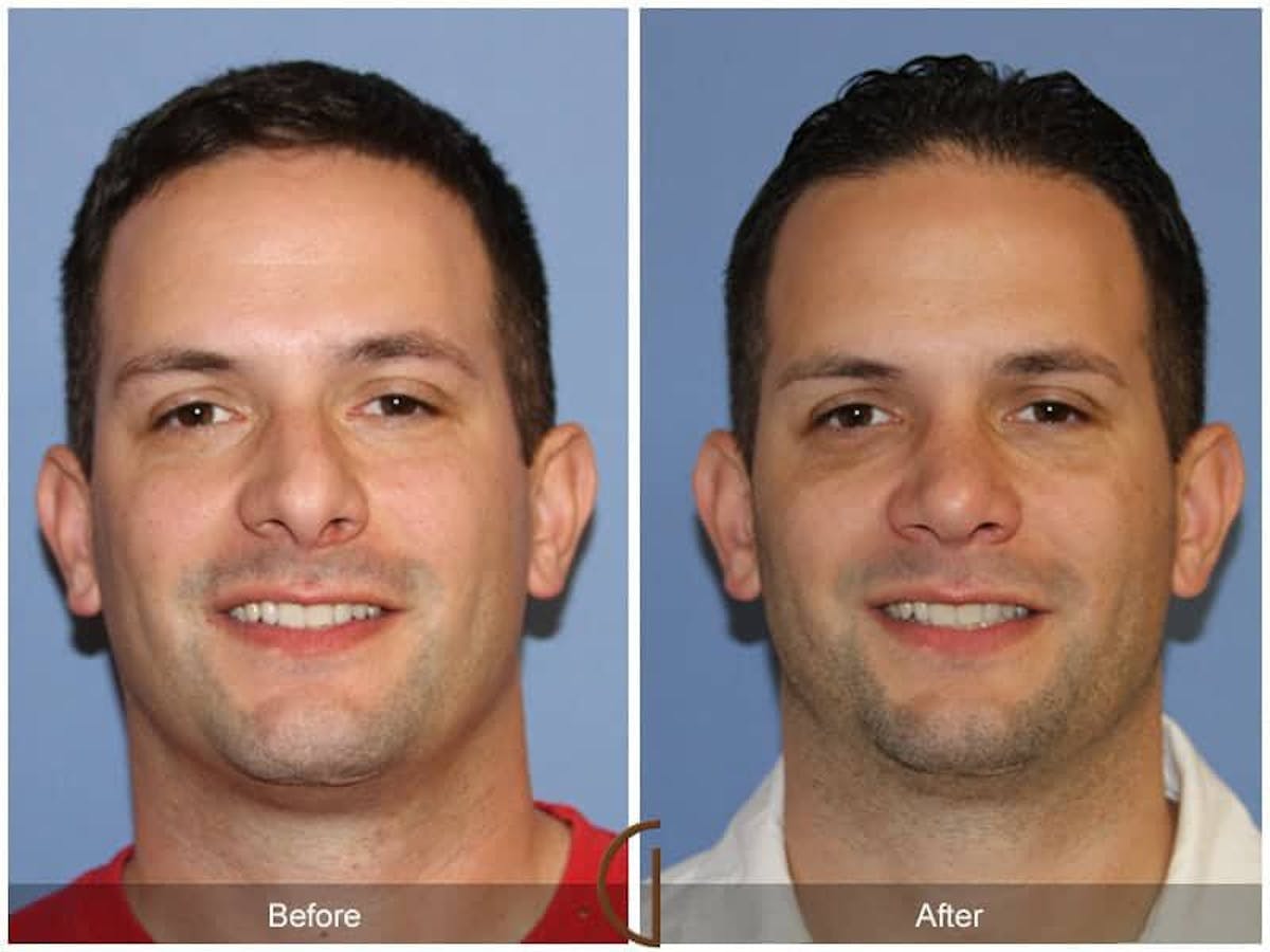 Male Rhinoplasty Before & After Gallery - Patient 248195 - Image 2