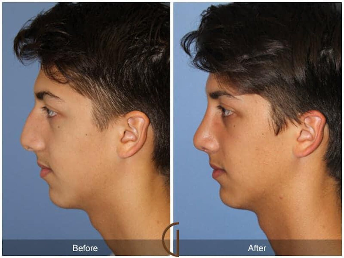 Male Rhinoplasty Before & After Gallery - Patient 166516 - Image 1