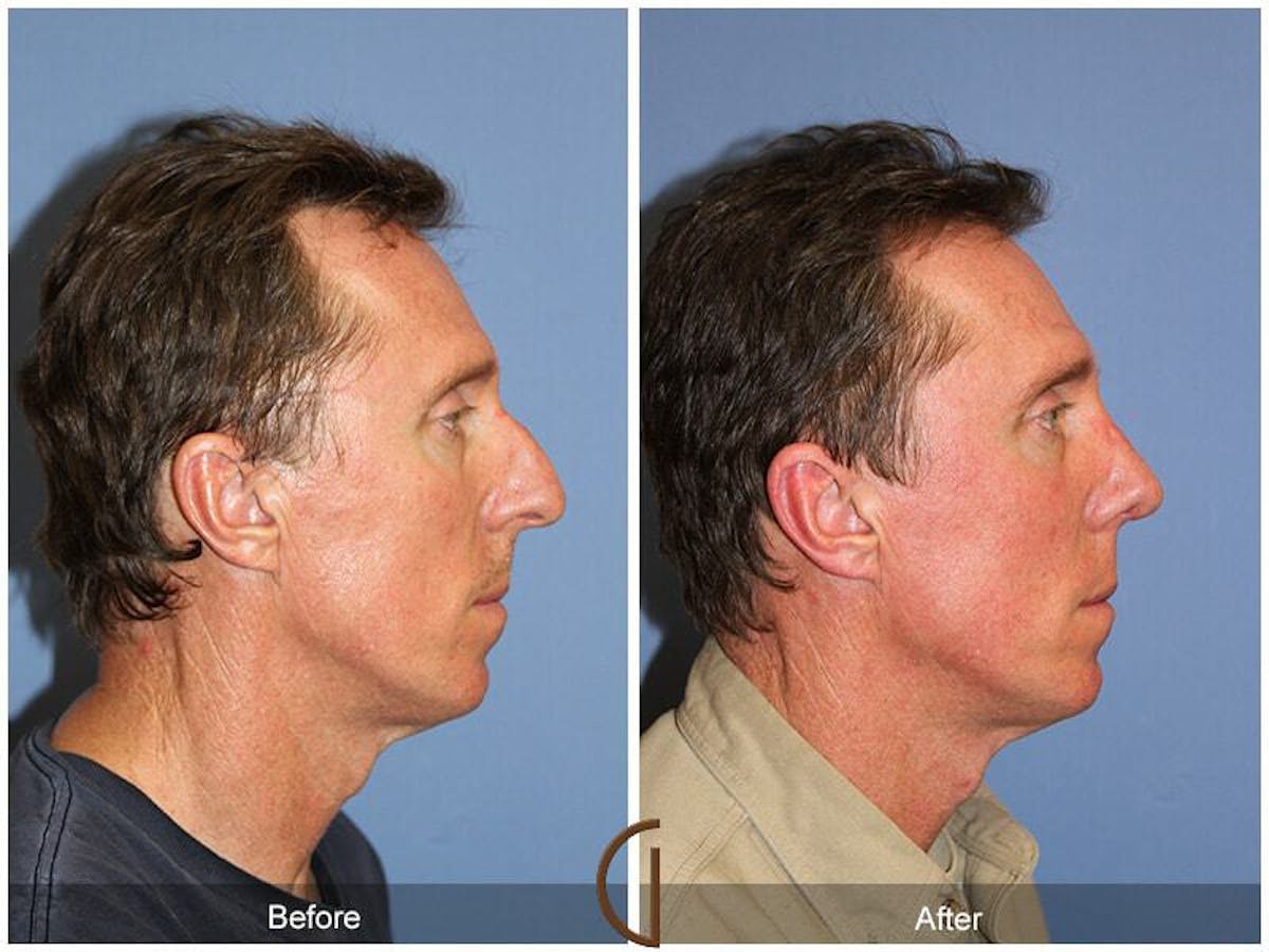 Male Rhinoplasty Before & After Gallery - Patient 639664 - Image 3