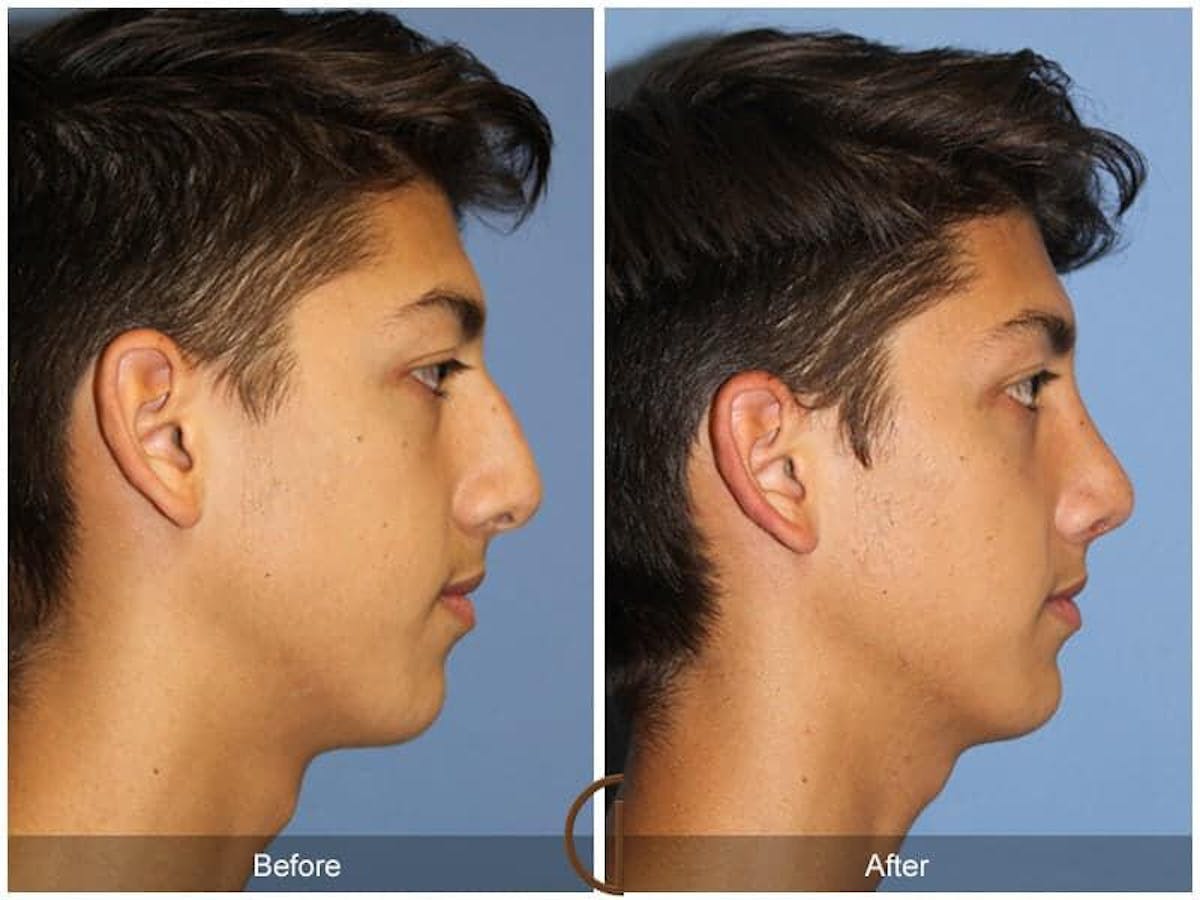 Male Rhinoplasty Before & After Gallery - Patient 166516 - Image 3