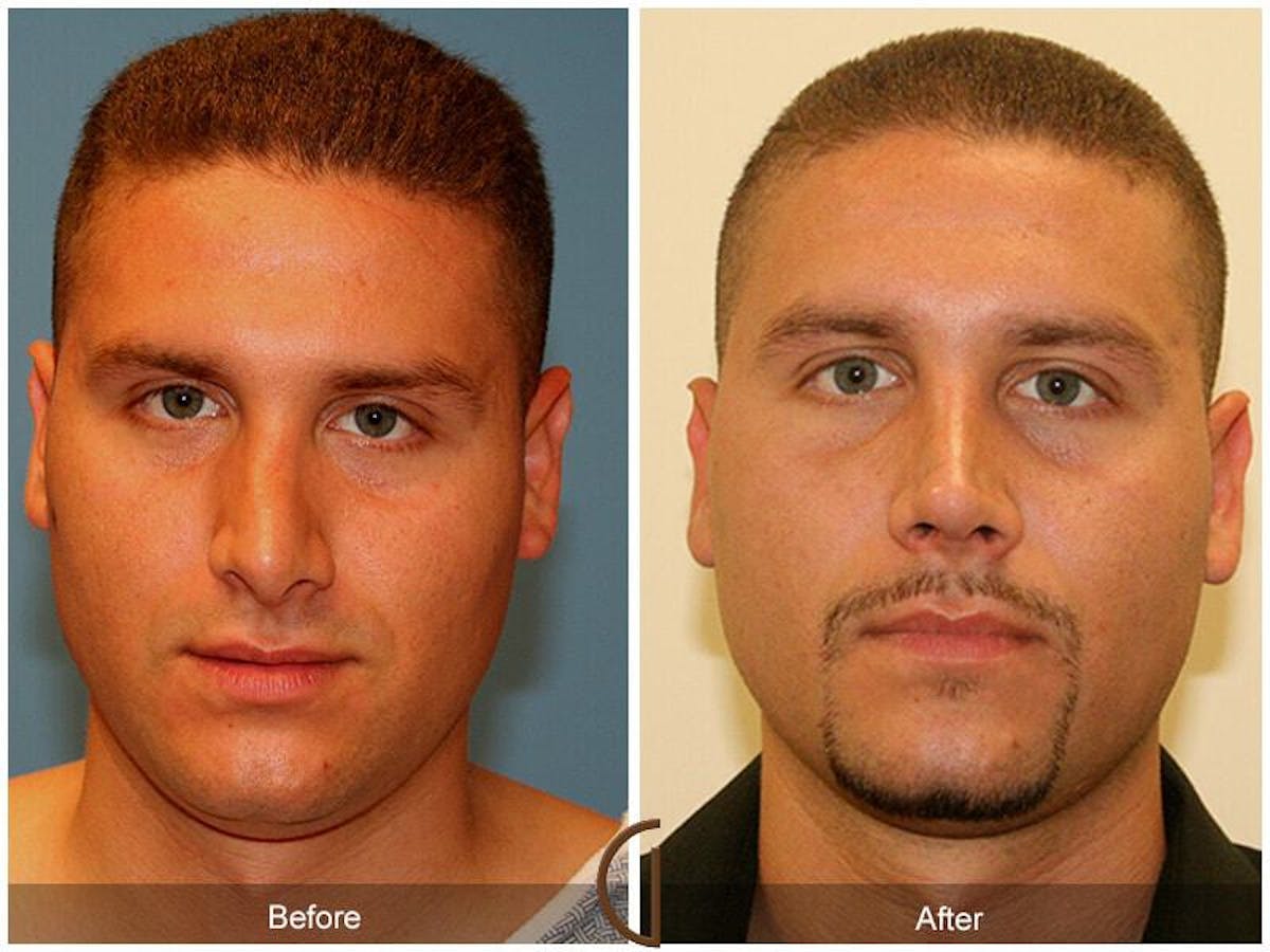 Male Rhinoplasty Before & After Gallery - Patient 176369 - Image 2