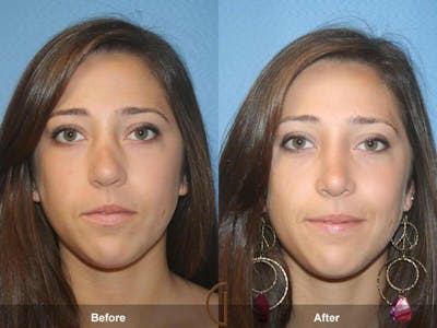 Female Rhinoplasty Before & After Gallery - Patient 407916 - Image 1