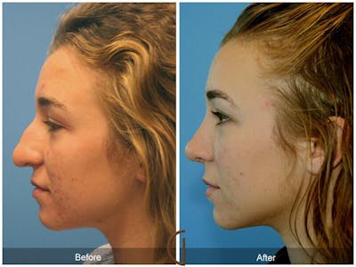 Female Rhinoplasty Before & After Gallery - Patient 408246 - Image 1