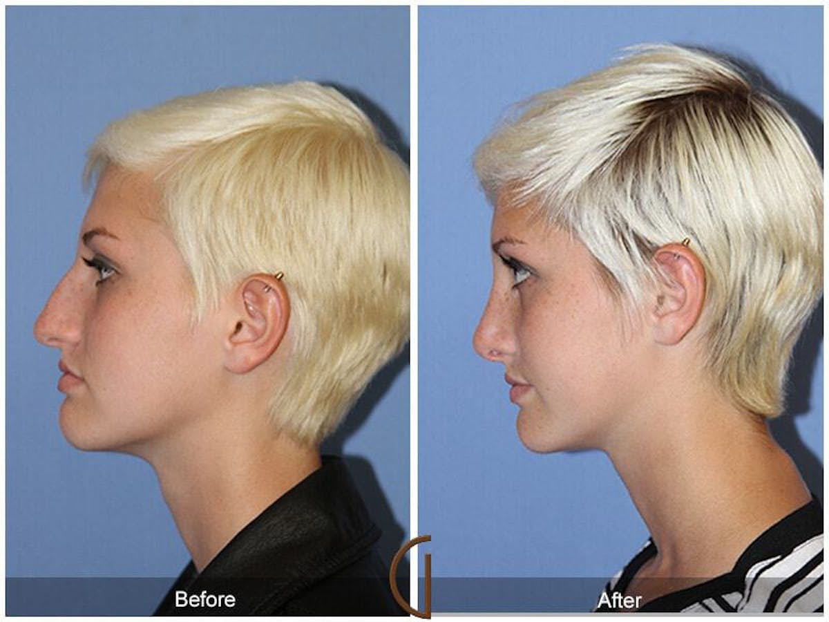 Female Rhinoplasty Before & After Gallery - Patient 837743 - Image 1