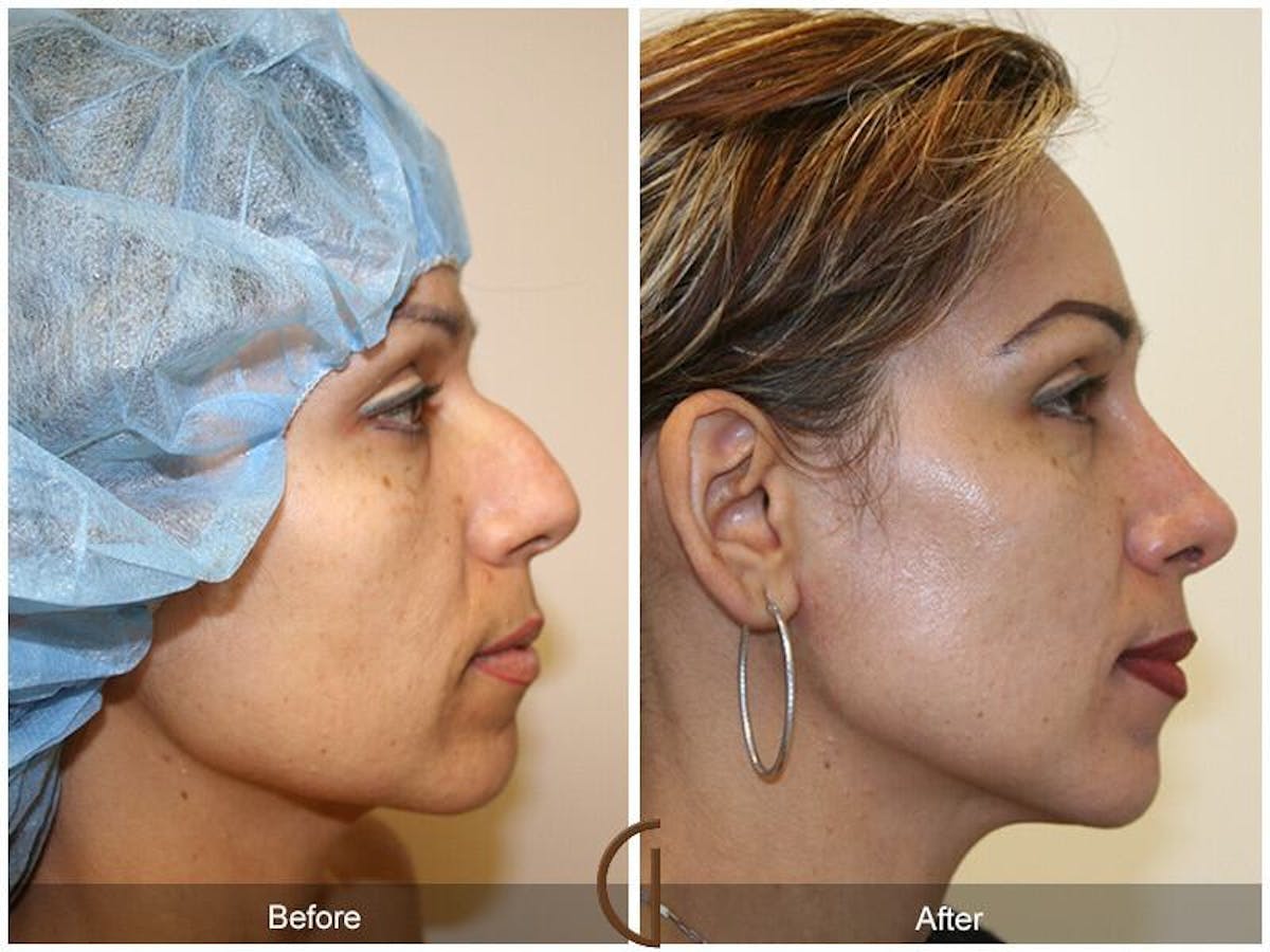 Female Rhinoplasty Before & After Gallery - Patient 234157 - Image 3