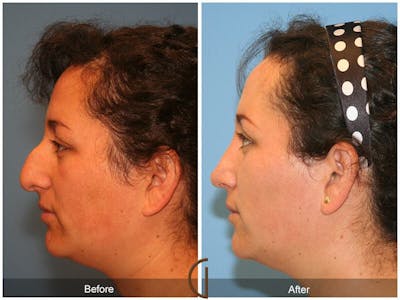 Female Rhinoplasty Before & After Gallery - Patient 741180 - Image 1
