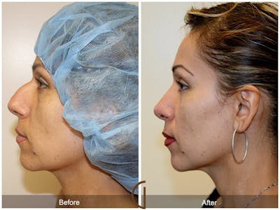 Female Rhinoplasty Before & After Gallery - Patient 234157 - Image 1
