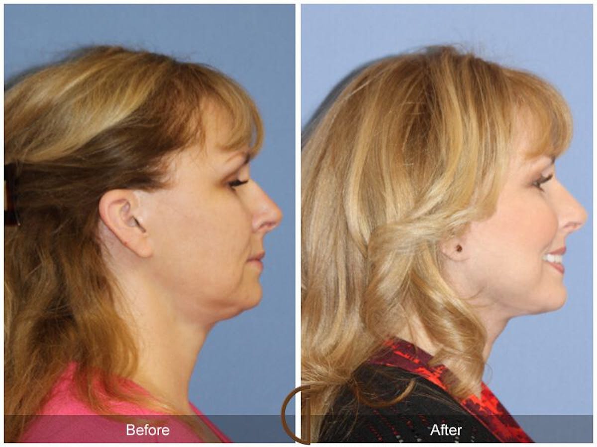 Facelift 50s Before & After Gallery - Patient 334678 - Image 3