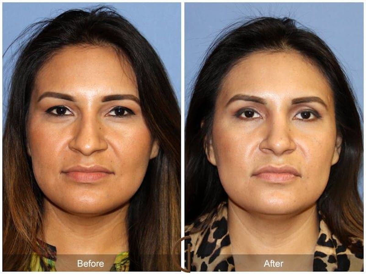 Ethnic Rhinoplasty Before & After Gallery - Patient 669058 - Image 2