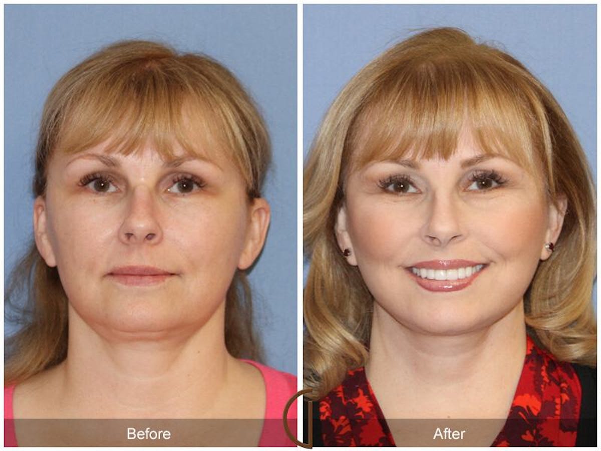 Facelift 50s Before & After Gallery - Patient 334678 - Image 2
