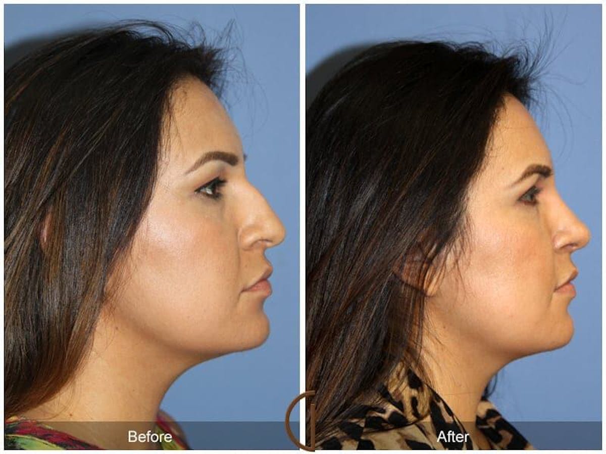 Ethnic Rhinoplasty Before & After Gallery - Patient 669058 - Image 3
