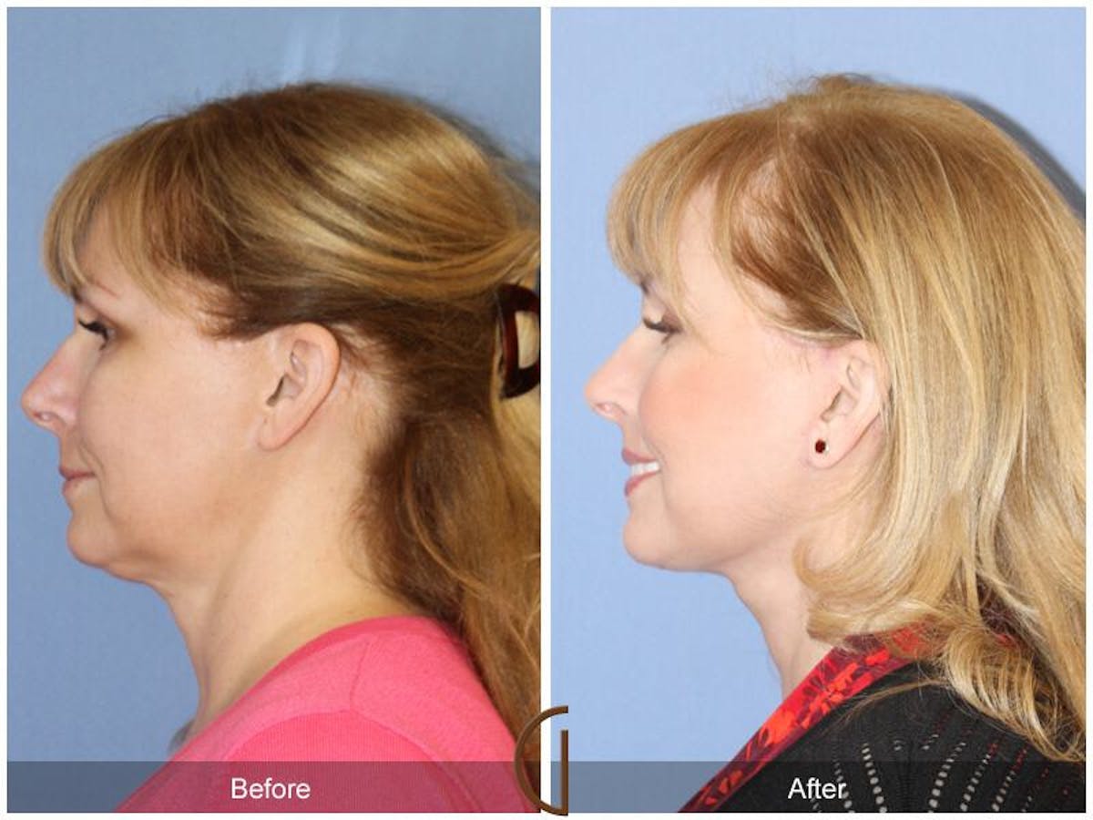 Facelift 50s Before & After Gallery - Patient 334678 - Image 1