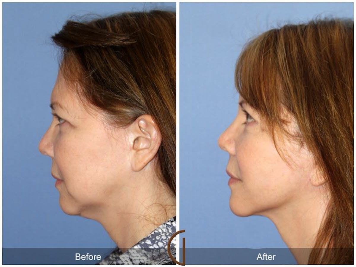 Facelift 60s Before & After Gallery - Patient 117910 - Image 1