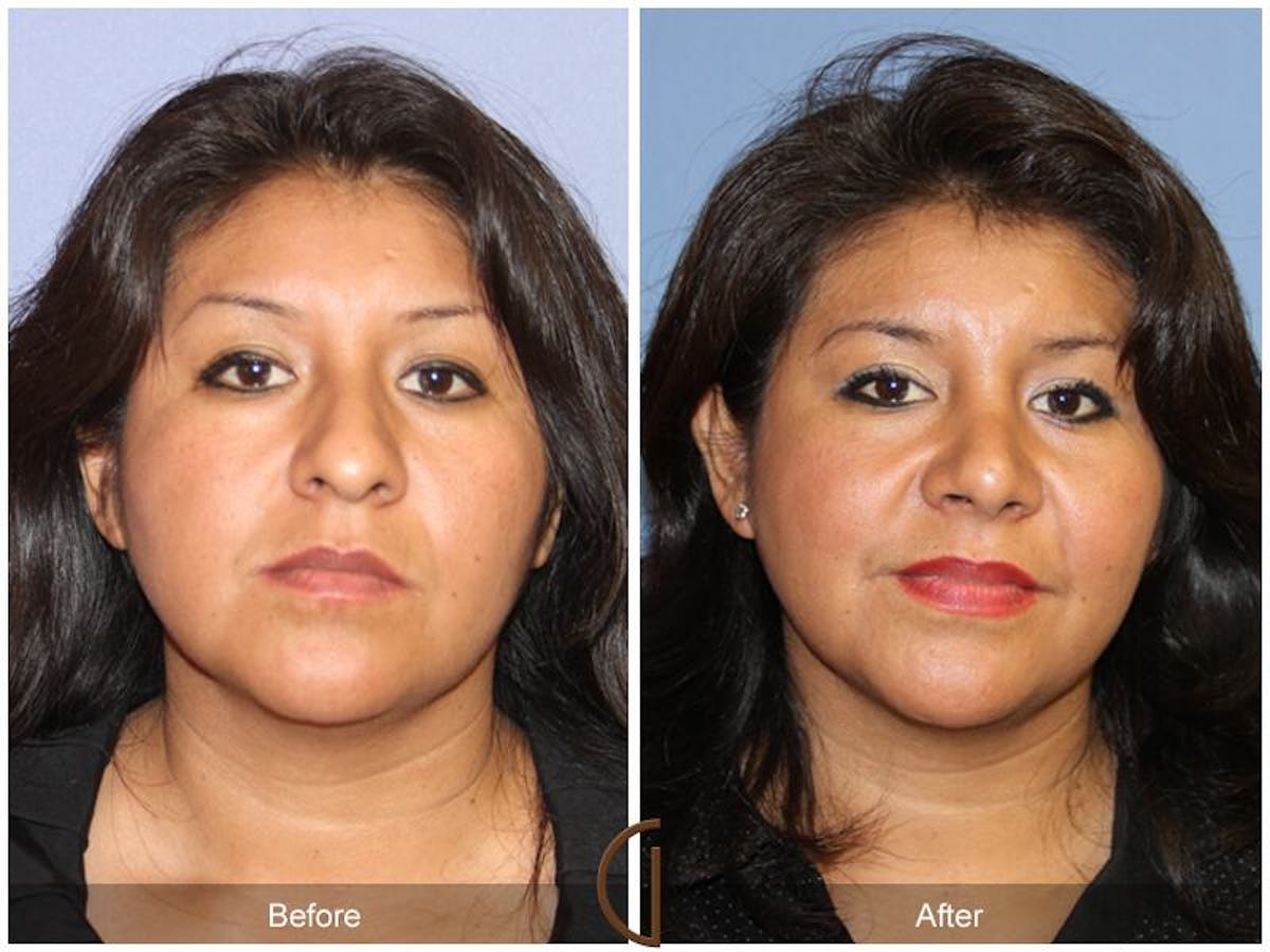 Ethnic Rhinoplasty Before & After Gallery - Patient 420624 - Image 2