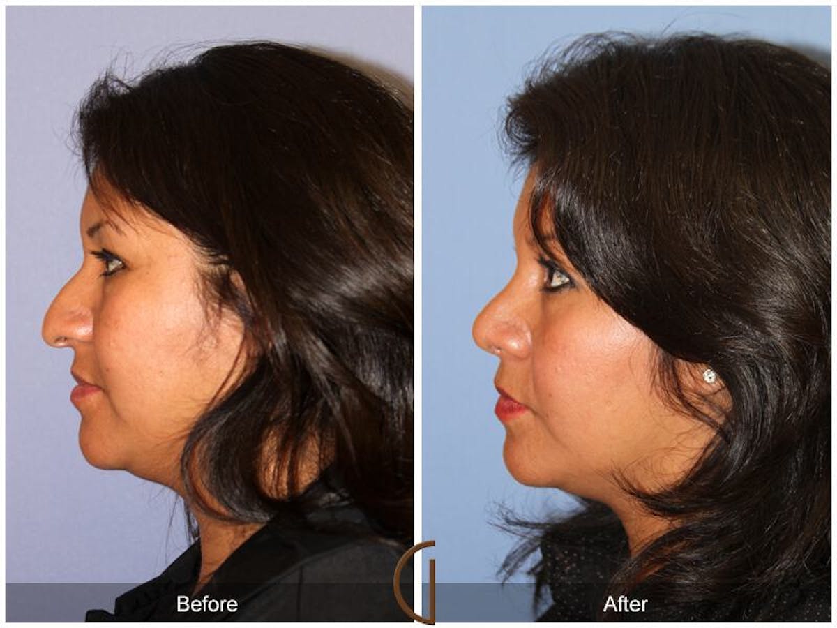 Ethnic Rhinoplasty Before & After Gallery - Patient 420624 - Image 1