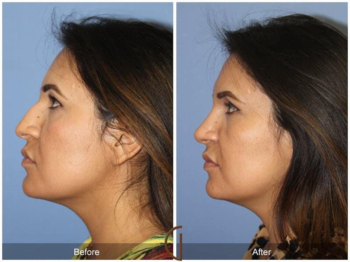 Ethnic Rhinoplasty Before & After Gallery - Patient 669058 - Image 1