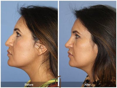 Ethnic Rhinoplasty Before & After Gallery - Patient 669058 - Image 1