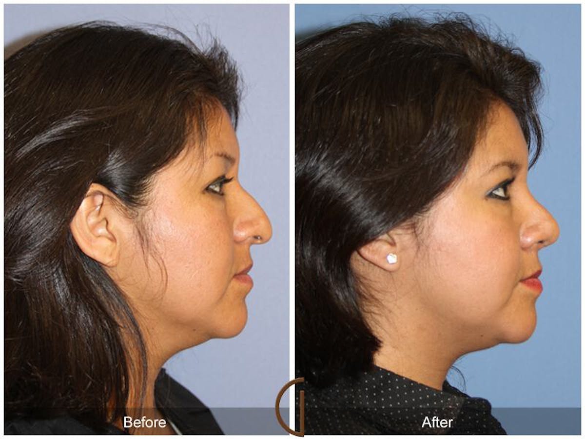 Ethnic Rhinoplasty Before & After Gallery - Patient 420624 - Image 3
