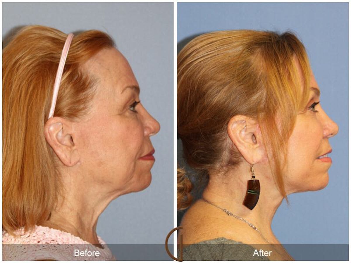 Facelift 60s Before & After Gallery - Patient 321846 - Image 3