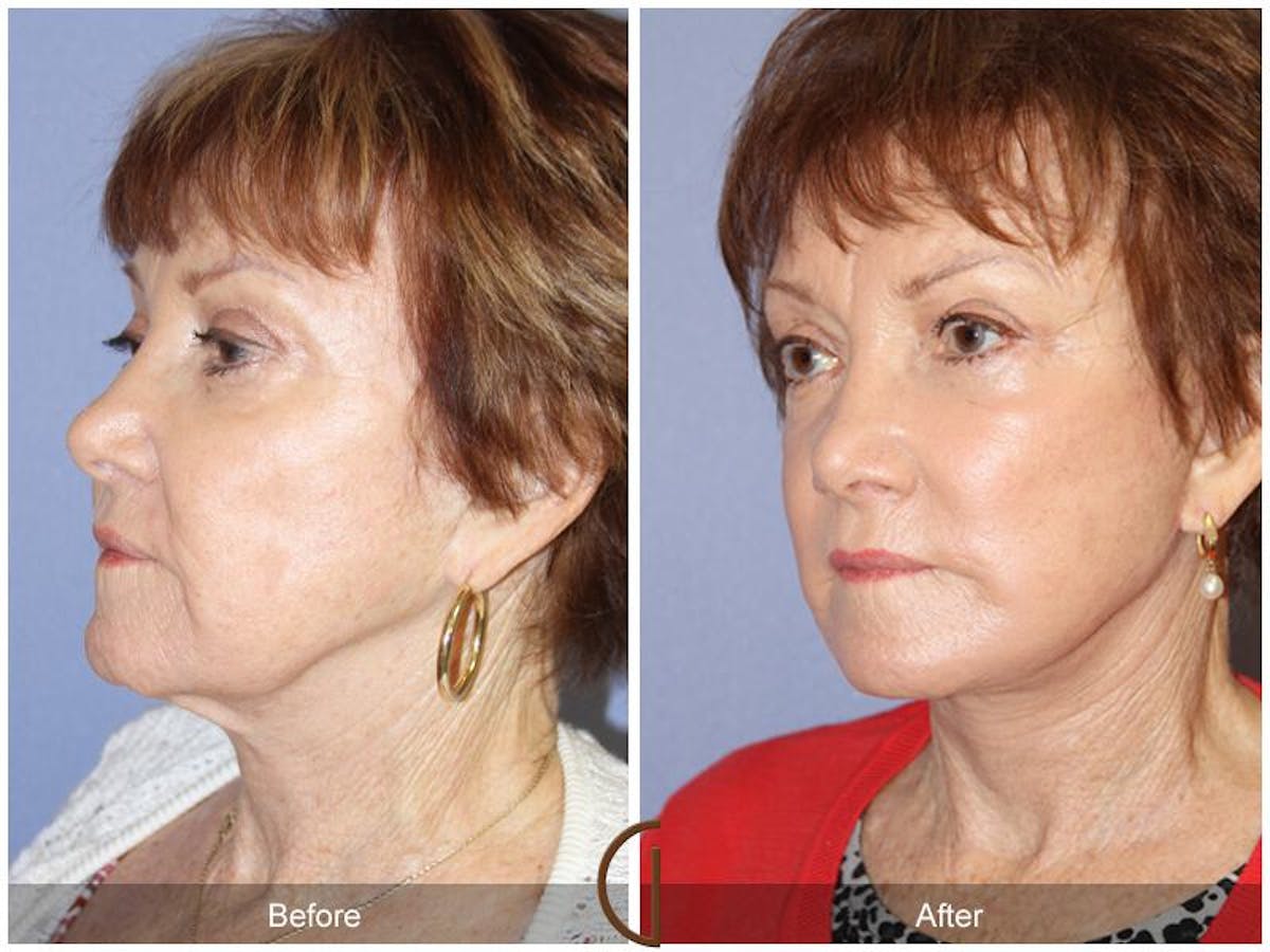 Facelift 70s Before & After Gallery - Patient 285599 - Image 1