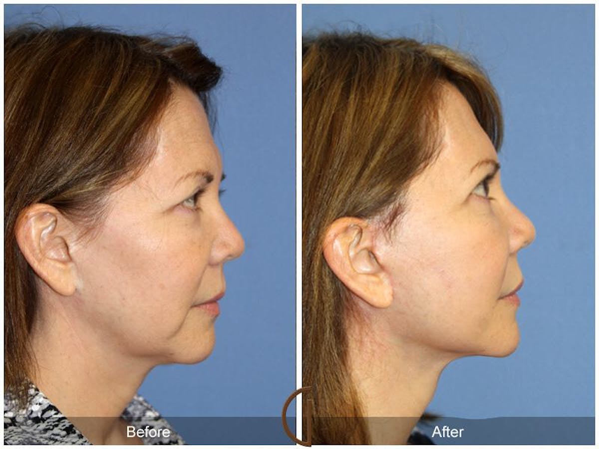 Facelift 60s Before & After Gallery - Patient 117910 - Image 3