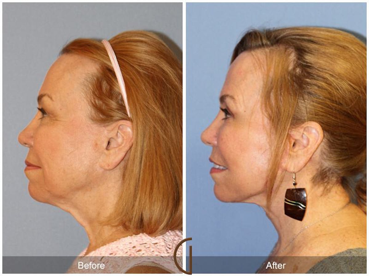 Facelift 60s Before & After Gallery - Patient 321846 - Image 1